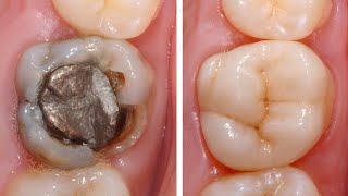 DRendo  Complex rehabilitation of a severely broken down maxillary molar maintaining pulp vitality [upl. by Ailegave]