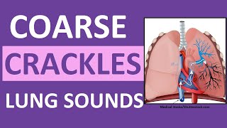 Crackles Coarse Lung Sounds  Crackles and Rales Breath Sounds Abnormal [upl. by Ahseined]