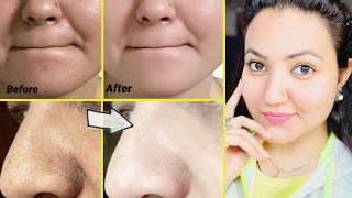 कितने भी मुश्किल Blackheads Whiteheads कील सफेद दाने हों follow करें ये 5 steps और पाएँ चमकदार skin [upl. by Aenitsirhc]