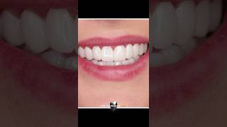 The Best Smile Design of 2024 with Cosmetic Veneers [upl. by Rubel648]