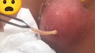 HEARD A CYSTIC ACNE OR BOIL blackheads inrown hair pimples [upl. by Adama]