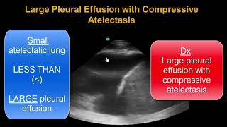 Lung Ultrasound Consolidation  Atelectasis or Pneumonia [upl. by Lacombe]