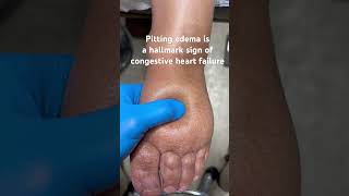 Pitting Edema Is A Sign Of Congestive Heart Failure [upl. by Uta813]