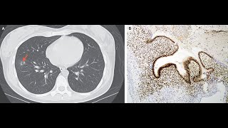 Thorakale Endometriose [upl. by Ahsino]