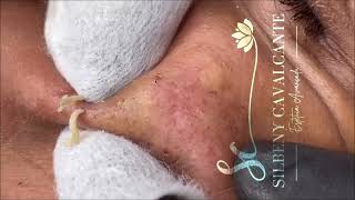 ACNE TREATMENT  Super Satisfying blackheads  004 [upl. by Qiratla465]