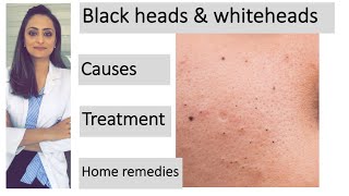 How to remove blackheads amp whiteheads Causes Treatment  Home remedies dermatologist [upl. by Nylrad]