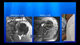 Ultrasound of SubcoracoidSubdeltoid Bursitis amp Partial vs SmallFull Thickness Supraspinatus Tear [upl. by Dam889]