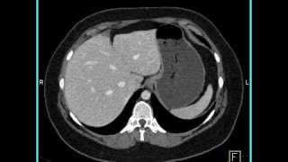 Abdomen Liver Focal Nodular Hyperplasia CT Angiography5 of 6 [upl. by Geis181]