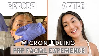 Full PRP Facial  Microneedling Experience  BeforeAfter Recovery [upl. by Fronia]