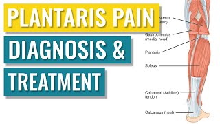 Plantaris Tendonitis  Symptoms and Treatment [upl. by Shelden]