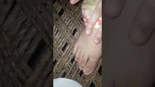 Trichophyton rubrum fungus nailinfection dermatology medical dermatology diagnosis foot [upl. by Ellesor85]