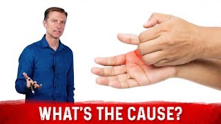 What Causes Sweaty  Dry Hands amp How To Get Rid Of It – Dr Berg [upl. by Eleik]