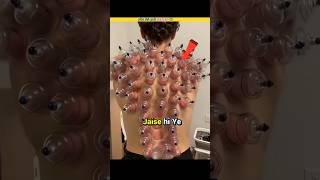 Cupping Therapy ।shorts facts [upl. by Allana]