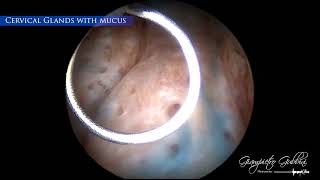 Clinical case Endocervical Ablation with GUBBINI MiniHysteroResectoscope by Dr Gubbini [upl. by Nasus844]