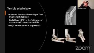 Acute Elbow Instability [upl. by Deppy]