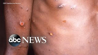 The symptoms treatment for monkeypox l ABC News [upl. by Sabsay314]