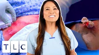 The Top 3 Most Watched Pimple Popping Moments  Dr Pimple Popper [upl. by Airalav]