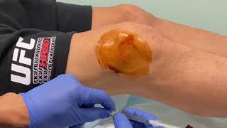 MoraMD Knee Effusion Aspiration A Nearly Painless Technique [upl. by Tigdirb225]