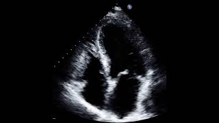 ACINESIA DA PONTA DO VENTRÍCULO ESQUERDO  CARDIOPATIA ISQUÊMICA COM VENTRICULO REMODELADO [upl. by Eiramnaej]