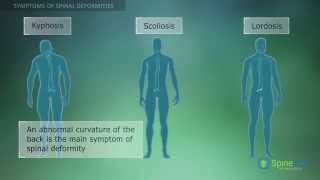 Spinal Deformities Symptoms [upl. by Alanna]