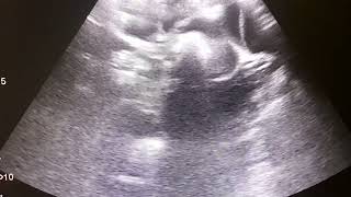 Intussusception  Saline Reduction  Ultrasound Guided  Radiology [upl. by Lyrret734]