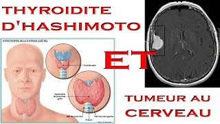 Mes problèmes de santé Thyroïdite dhashimoto et Tumeur au cerveau [upl. by Aicatsue]