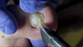 Ingrown Toenail Removal  Pedicure Treatment and Very Satisfying  Best Satisfying Nail Cutting [upl. by Hilton]