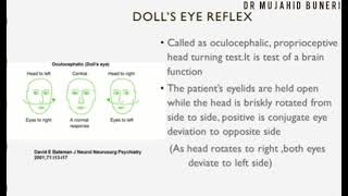 Dolls Eye Reflex  Oculocephalic Reflex  Brain death  Dr M B [upl. by Becket]