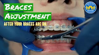 How Do Braces Straighten Teeth [upl. by Hazeghi]