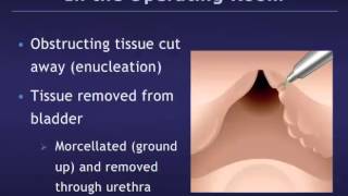 Holmium Laser Enucleation of the Prostate HoLEP for Benign Prostatic Hyperplasia BPH [upl. by Sarnoff]