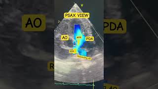 PDA Patent Ductus Arteriosus Pediatric Echo ♥️ [upl. by Llerrat]