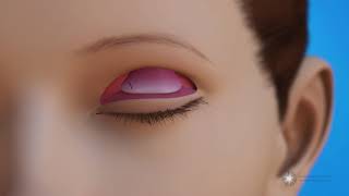 Levator Resection for Ptosis Repair Surgery Eyelid Lift [upl. by Purcell]