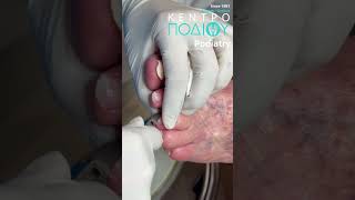 Nails Treatment callus κεντροποδιου kentropodiou podiatry podiatria podologia podiatrist [upl. by Eileen]