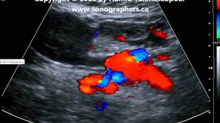 Thrombosed Superior Mesenteric Vein from Cancer of Pancreaswmv [upl. by Chaim]