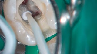 DRendo  Full pulp chamber pulpotomy in a mandibular second molar [upl. by Dnalsor]