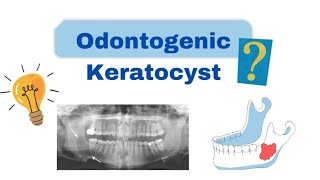 Odontogenic Keratocyst OKC  Oral Pathology  Dental lectures [upl. by Brit]