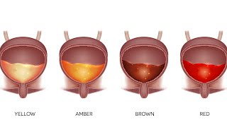 Iata ce spune culoarea urinei despre sanatatea ta [upl. by Jessee]