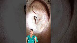 Ear Wax Removal 8 [upl. by Cornell]