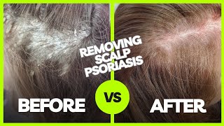 Removing Plaque Scalp Psoriasis  Using The AntiFungal Bundle myhappyscalpcom [upl. by Wildermuth]