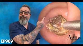 The MOST SATISFYING ring of dry ear wax removal EP989 [upl. by Ahsilav567]