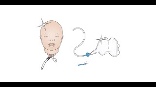 Resusci Baby QCPR  How to Upgrade to Airway Head [upl. by Poirer]