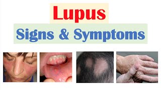 Lupus Signs amp Symptoms amp Why They Occur  Skin Joints Organ Systems [upl. by Roshelle]