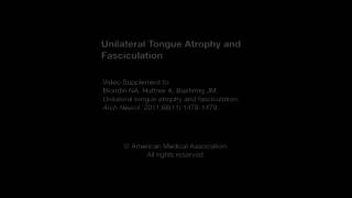 Unilateral Tongue Atrophy and Fasciculation [upl. by Uolyram]