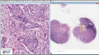 Breast Invasive carcinoma NST with lymph node metastases Microscopy Talking slide [upl. by Marne]