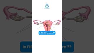 NonSurgical Fibroid Treatment Safe FDAApproved Solution  C3 Medicares Holistic Approach✨ [upl. by Ricketts]