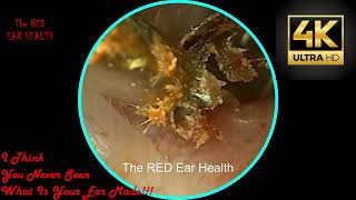 Want CLEAR Ears Watch This Deep Ear Wax Cleaning Now [upl. by Nauqel]