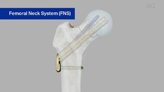 Femur Neck—Fracture 31B—Stabilization Using the Femoral Neck System FNS [upl. by Issim]