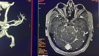 Malformación arteriovenosa asociada a hemorragia parenquimatosa y trombosis venosa… Fusión 3D [upl. by Mavilia]