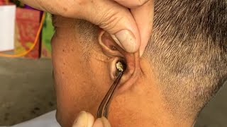 Removing ear blockage use manual tools [upl. by Asiral]