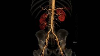 CT scan case 77Duplex kidney with triple renal arteriesctscan radiology radiologist radiologia [upl. by Htebaile]